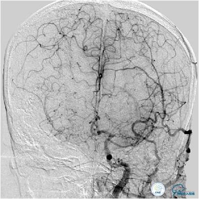 右侧大脑中动脉区可见两支血管,什么是左侧大脑中动脉代偿供血