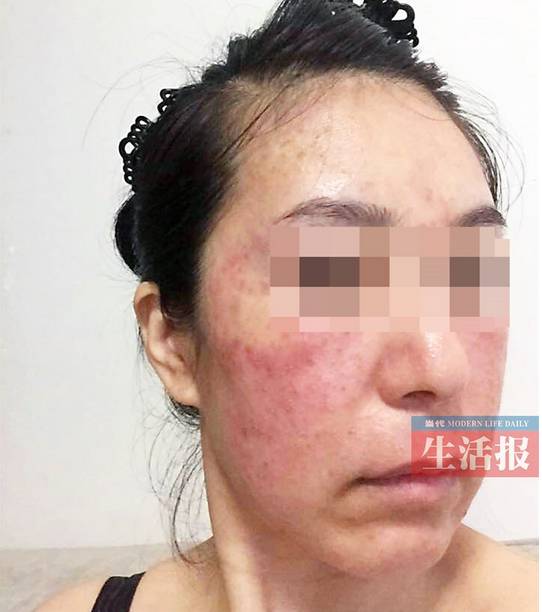 药水点痣毁容,美容院祛痣毁容