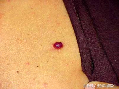 皮肤上有一细小点红痣是代表什么,脸上长的红痣能用药点吗