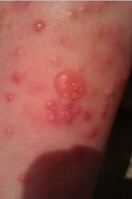 内蒙古跳蚤咬伤,跳蚤咬了怎么处理伤口