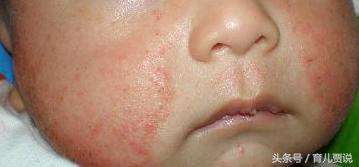 激素药膏不能用？宝宝湿疹治疗误区你中了几个？
