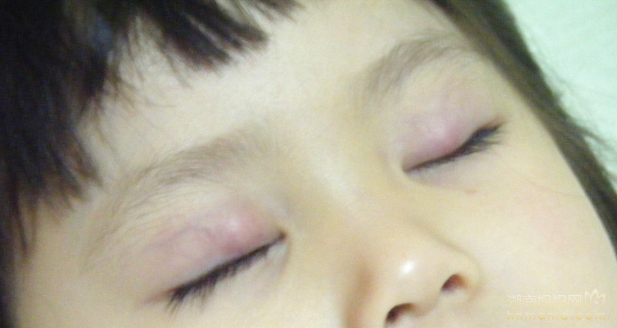 宝宝眼皮长痘痘是怎么回事,上下眼皮都长了豆豆怎么办