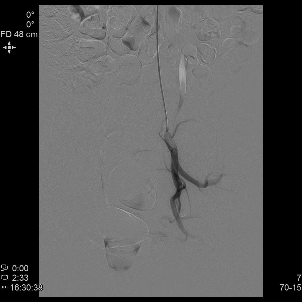 从手腕处做子宫动脉栓塞手术,子宫肌瘤做动脉穿刺有危险吗
