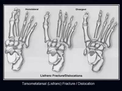 几种严重骨折医学名称,常见的骨折有哪些名称