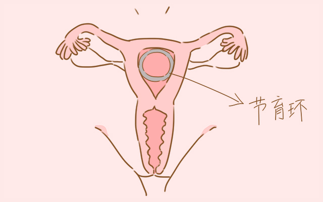 国外避孕方式有哪些,国外最好的避孕方式是什么