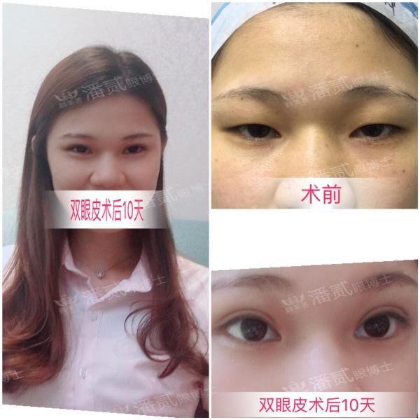 什么样的肿眼泡适合全切,什么样的肿眼泡不用动提肌