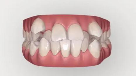 有牙齿的老虎怎么样,有老虎牙怎么拔