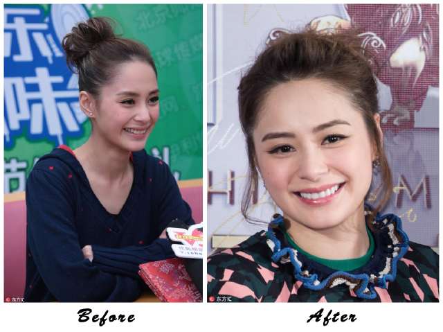 阿娇大龅牙,阿娇整牙