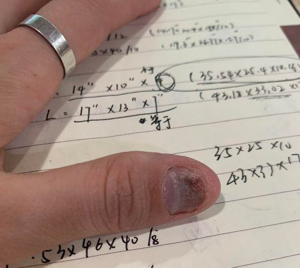 分享乙肝治愈路,分享养生知识辨别灰指甲