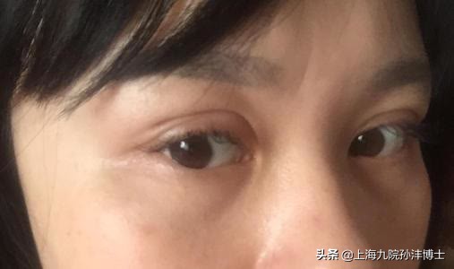 修复双眼皮眼角有分叉怎么办,双眼皮修复折痕分叉
