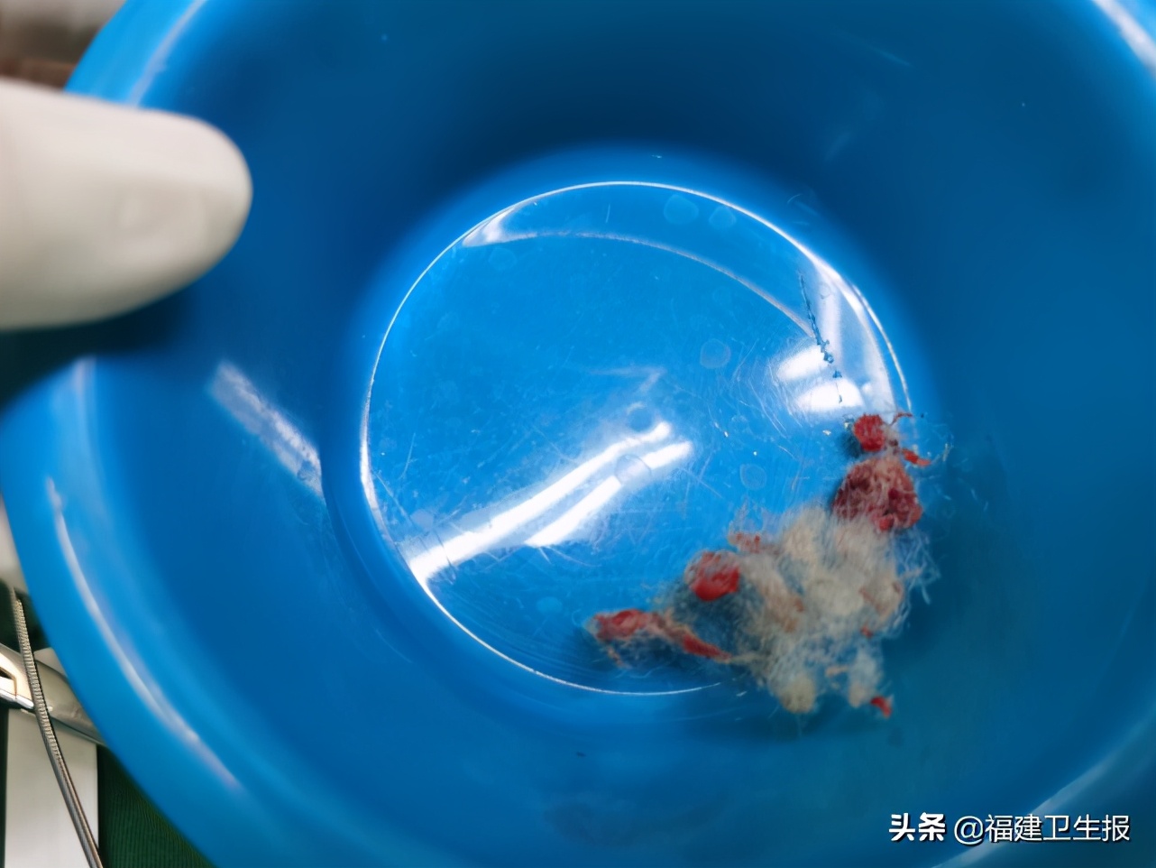 女幼童阴道炎症状治疗,女幼童阴道炎会有什么症状