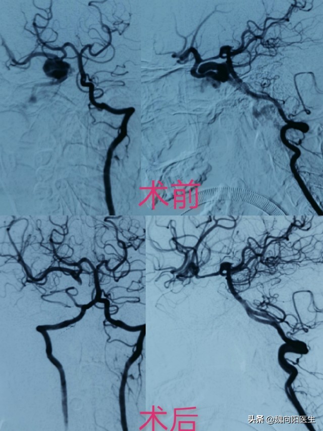 颈动脉海绵窦瘘症状,颈动脉海绵窦瘘介入需要多少钱