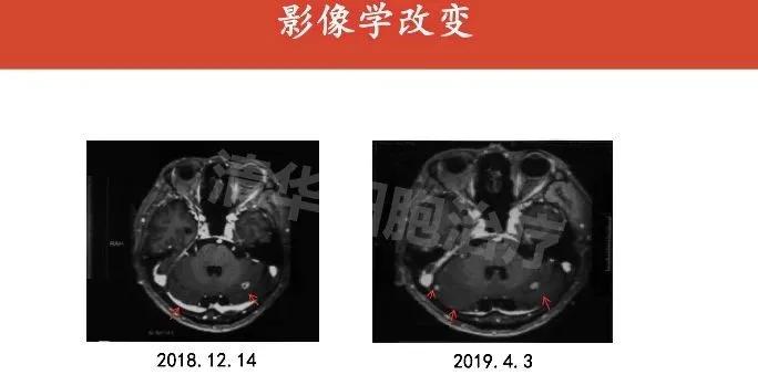 肺癌晚期活不了多久的症状,肺癌晚期生命只剩下六个月