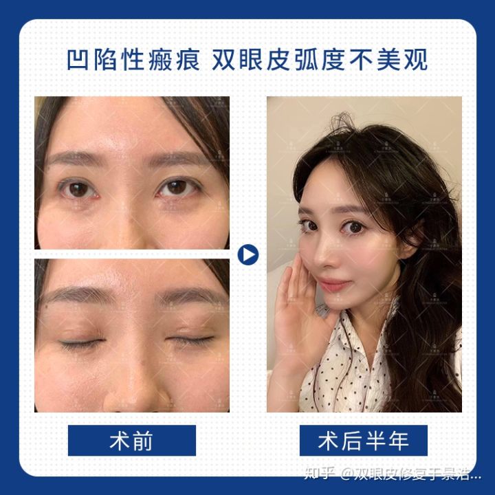 双眼皮割毁了可以修复吗,切开双眼皮失败可以用埋线修复吗