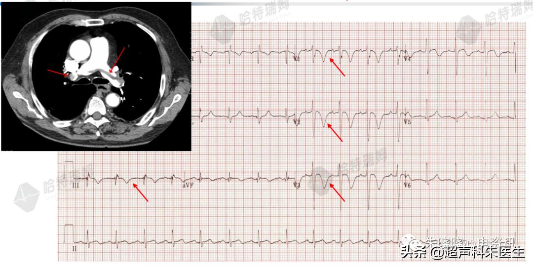 t波倒置诊断,t波倒置如何区分严重程度