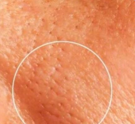 苨萃（NICUI）护肤：有哪些医美手段可以真正收缩毛孔？