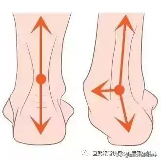 脚后跟尿酸堆积痛怎么缓解,缓解脚后跟痛踩台阶视频