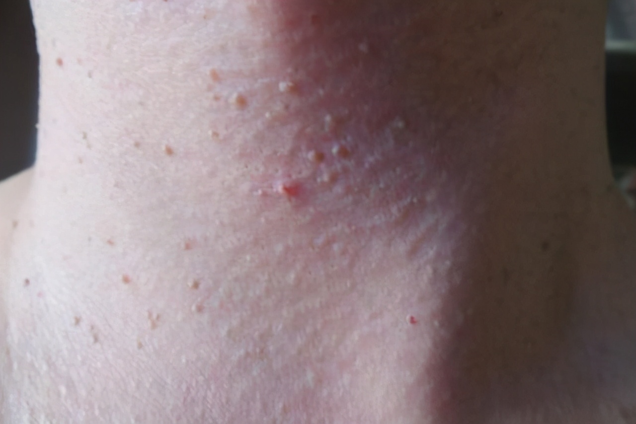 脖子和胳肢窝,脖子两侧胳肢窝有细肉怎么办