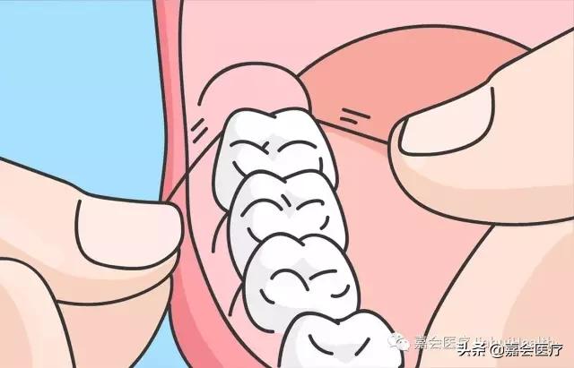 刷完牙用牙线清理牙垢多余吗,刷牙只能清洁70%的牙齿