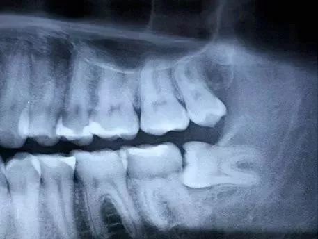 为什么拔智齿那么疼,为什么拔智齿会痛这么久