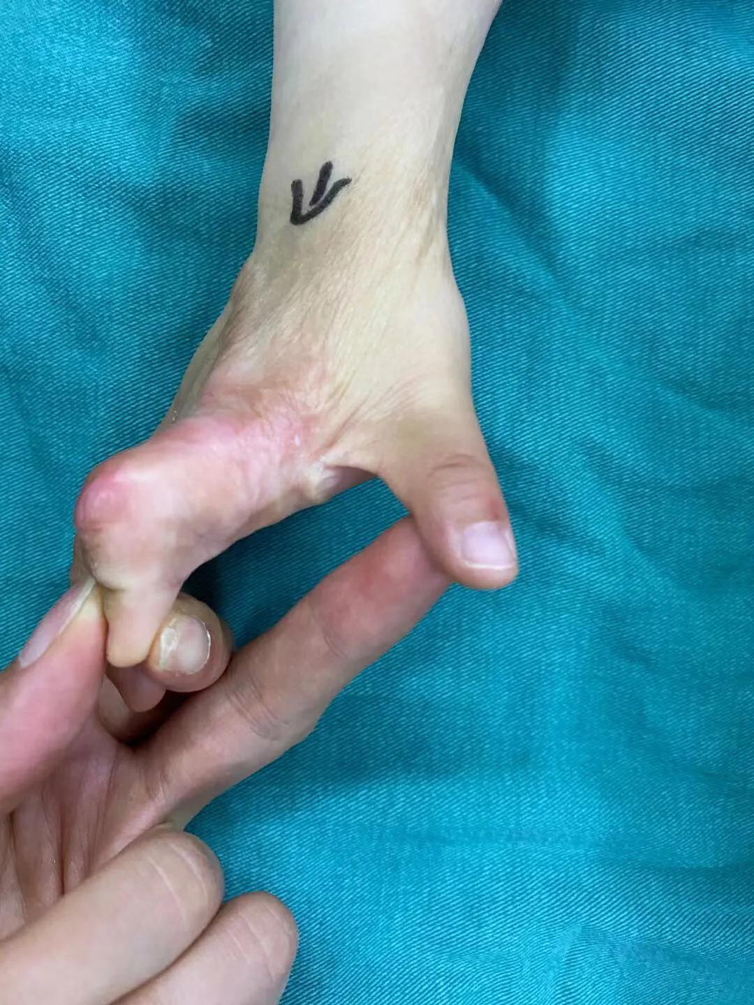 儿童烫伤的疤痕,三度烫伤疤痕为啥挛缩