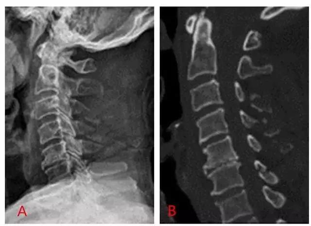 所有骨折都叫什么名字,骨折的名称有哪些