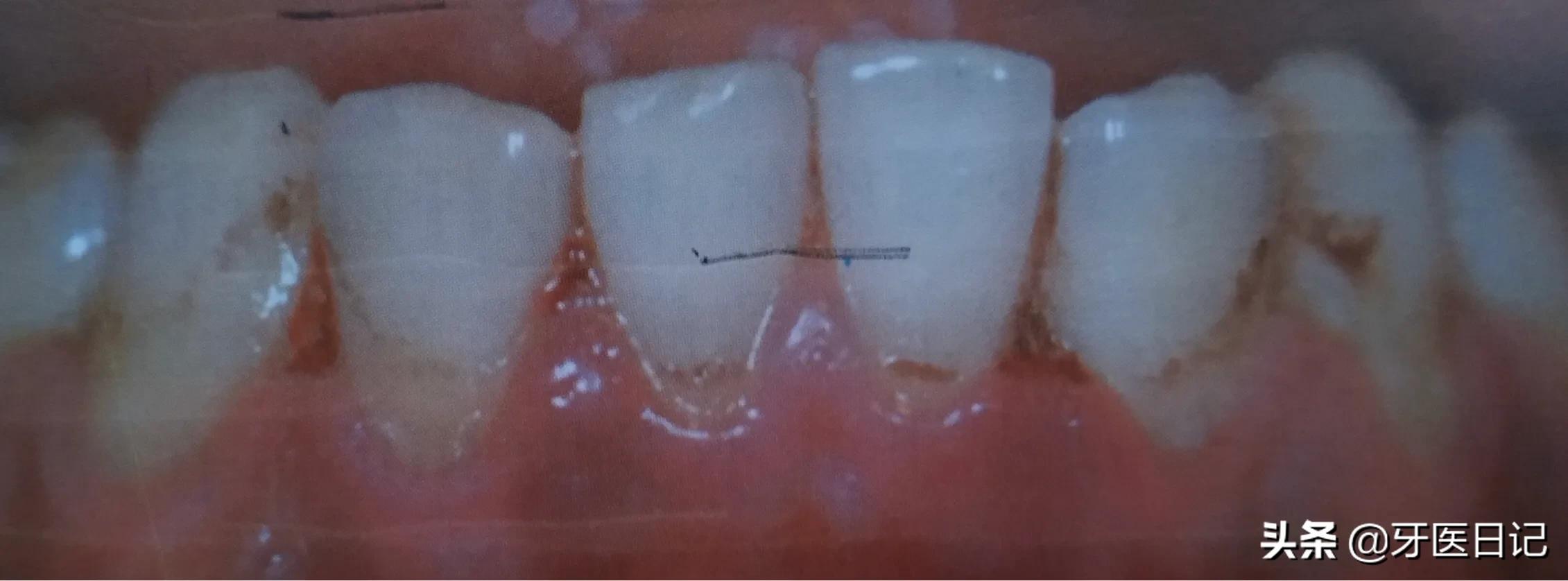 牙龈上火肿了吃什么药,牙龈肿了个肉坨上火疼