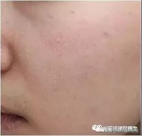 李佳琦推荐的福瑞达玻尿酸安瓶,福瑞达玻尿酸玻色因
