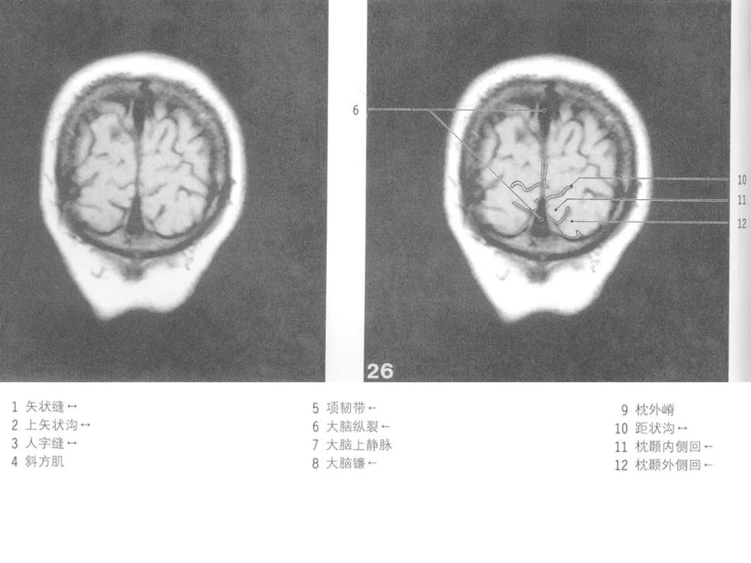 颅脑冠状状切面解剖图,颅脑mr解剖结构图