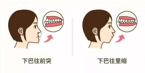 正畸日记补牙,正畸刚戴上牙套的不适应有哪些