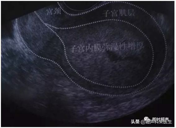 妇科常见疾病的超声诊断视频,超声常见疾病
