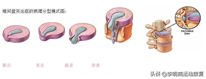 腰痛的最快的恢复办法,腰痛腰间盘突出自行康复
