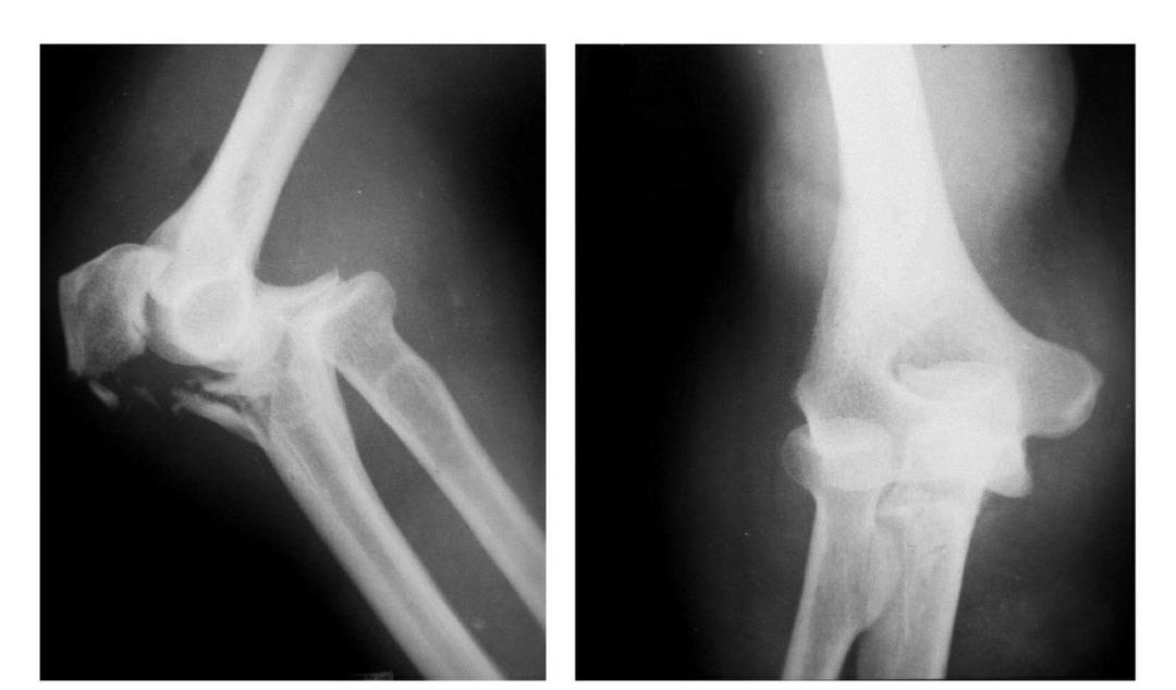 青少年肘部损伤最常见的是,肘部桡神经损伤的临床表现