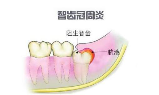 智齿冠周炎剧痛怎么缓解疼痛,智齿冠周炎急性怎么缓解疼痛