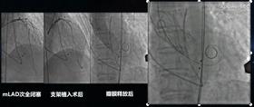 安贞医院冠心病介入治疗新技术,冠心病介入术