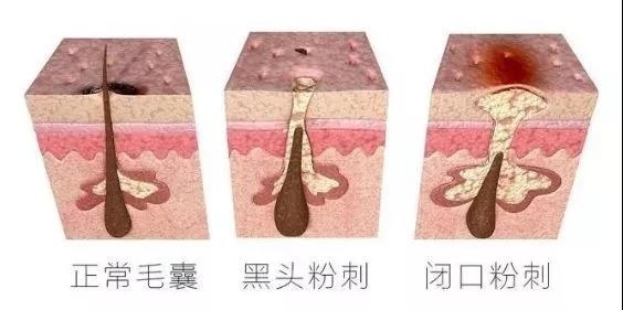 满脸都是闭口,满脸都是闭口的状态