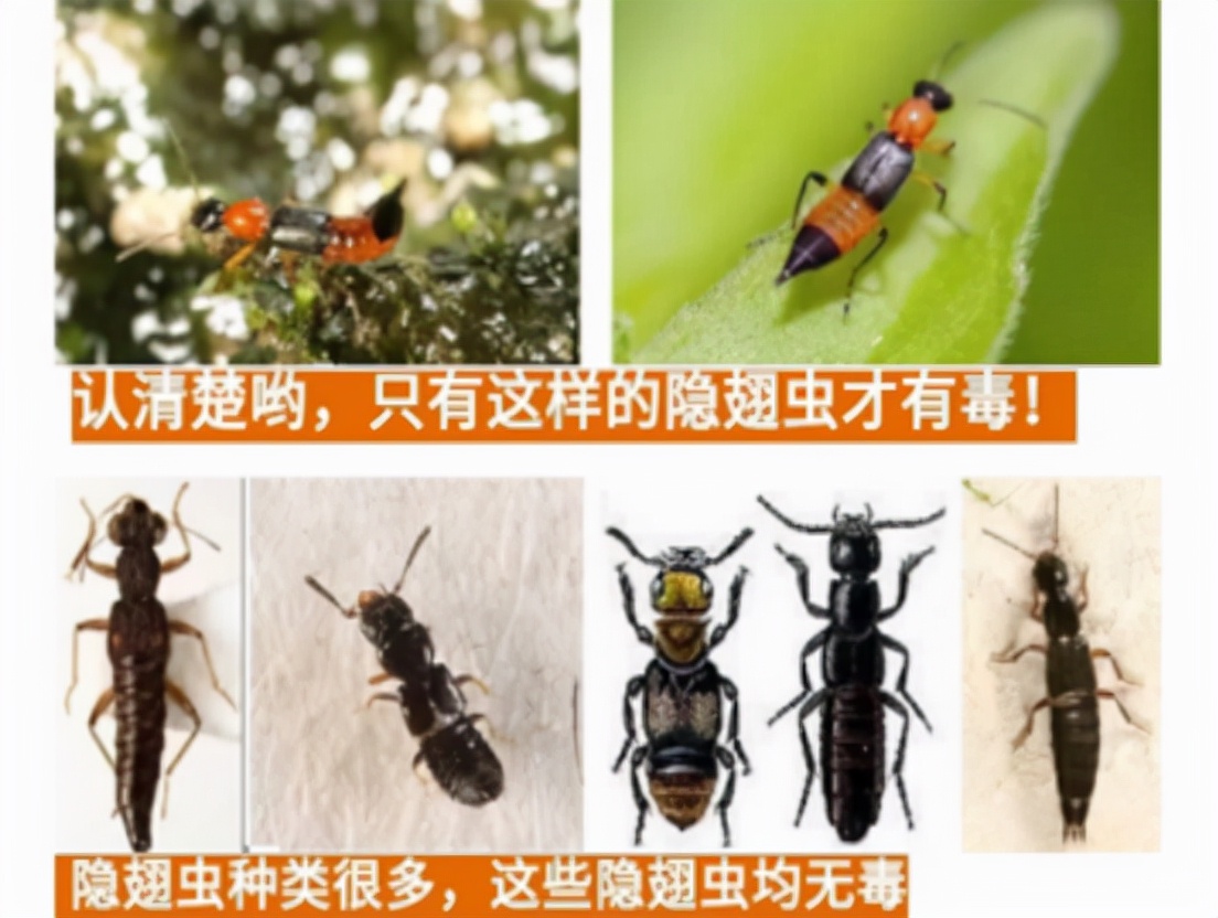 被隐翅虫毒液沾到涂什么药膏,被隐翅虫咬伤特效药