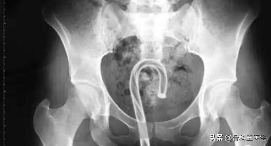 为什么有人会往直肠塞异物,为什么很多人都向直肠里塞异物