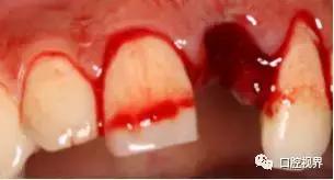 门牙撞了怎么办,门牙碎了你怎么办