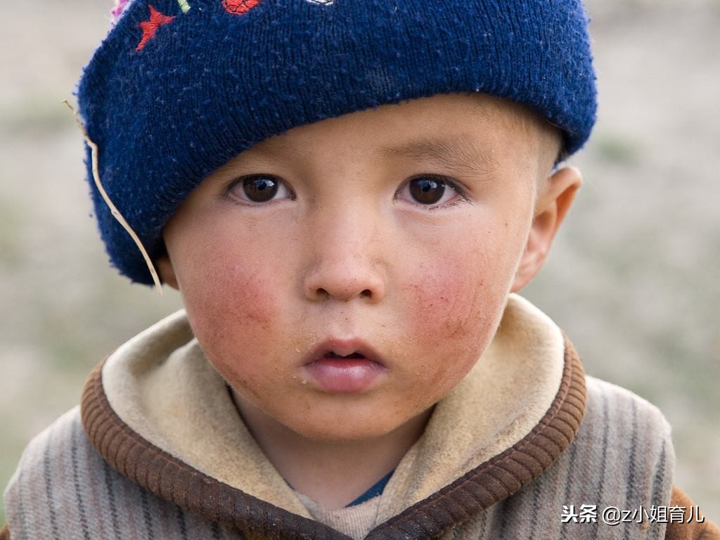 宝宝皮肤冻伤怎么办,宝宝冻疮破皮怎么尽快好