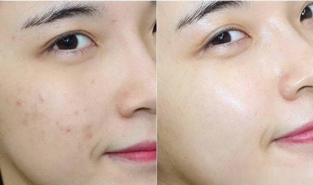 分享祛痘过程博主,分享自己治疗痘痘的经历