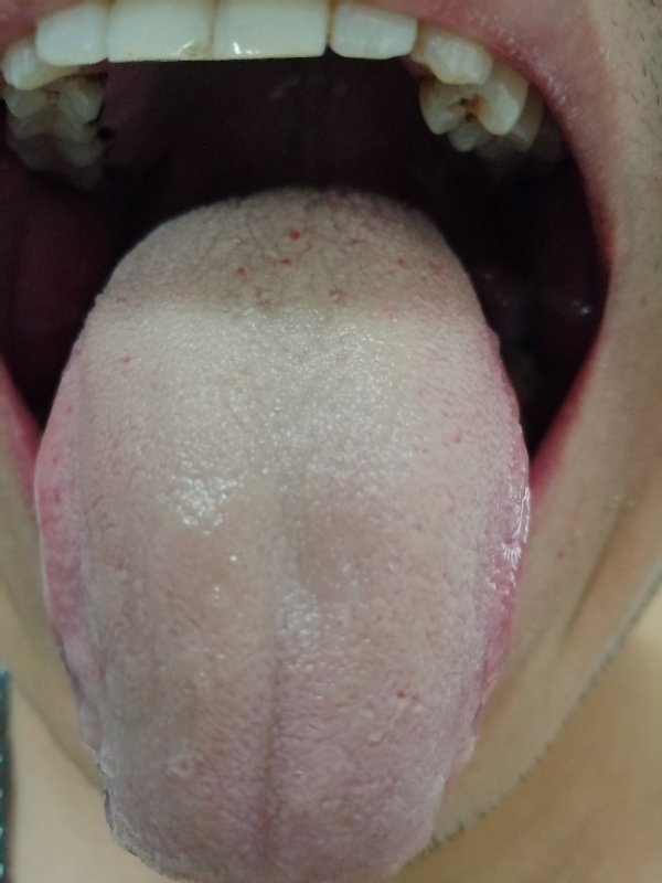 尿频尿急尿液有泡沫是肾病吗,湿气重小便会有什么症状