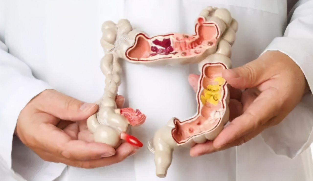 肠镜能判断出来直肠癌严重程度吗,直肠癌早期能通过肠镜发现吗