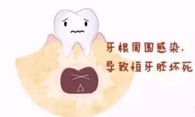 小孩乳牙有龋齿需要治疗吗,孩子乳牙门牙有点龋齿需要补牙吗