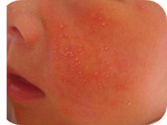 宝宝湿疹用什么药膏,宝宝脸上湿疹怎么办