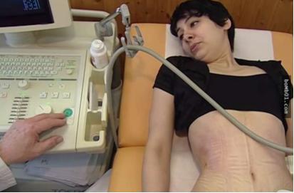 内脏下垂、子宫脱落、漏尿…那些被「网红束腰」毁掉的女孩