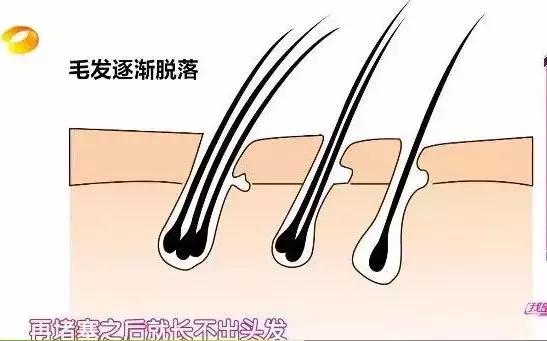 头发毛躁并且脱发推荐洗发水,用什么洗发水改善头皮脱发