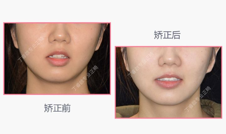 单颗牙隐形矫正,郑州隐形矫正牙齿哪家便宜