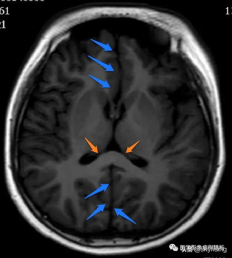 半叶全前脑畸形,无叶型前脑无裂畸形超声表现