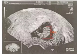 怀孕多久做B超比较好,怀孕多久做b超可以查到孕囊